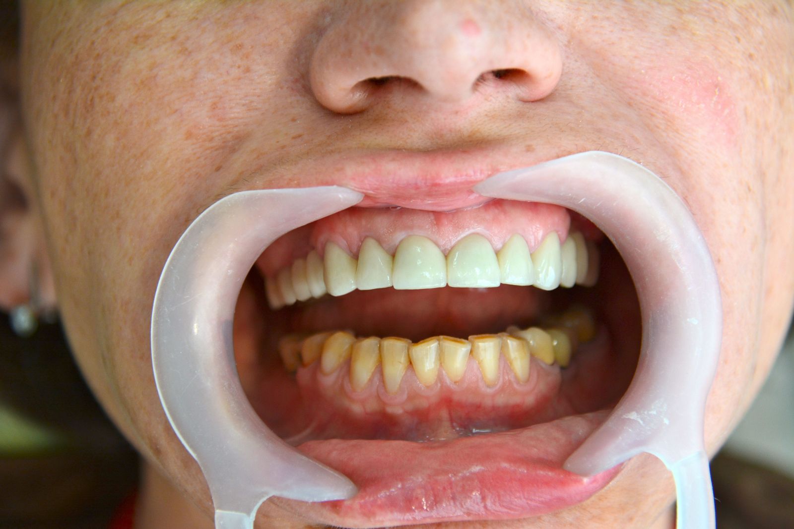 Бюгельные зубные протезы установка фото до и после лечения 