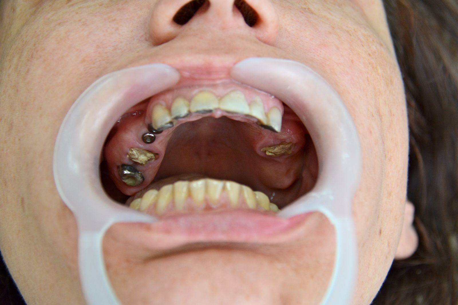Протезирование зубов в Белоруссии, стоматологические услуги в Минске