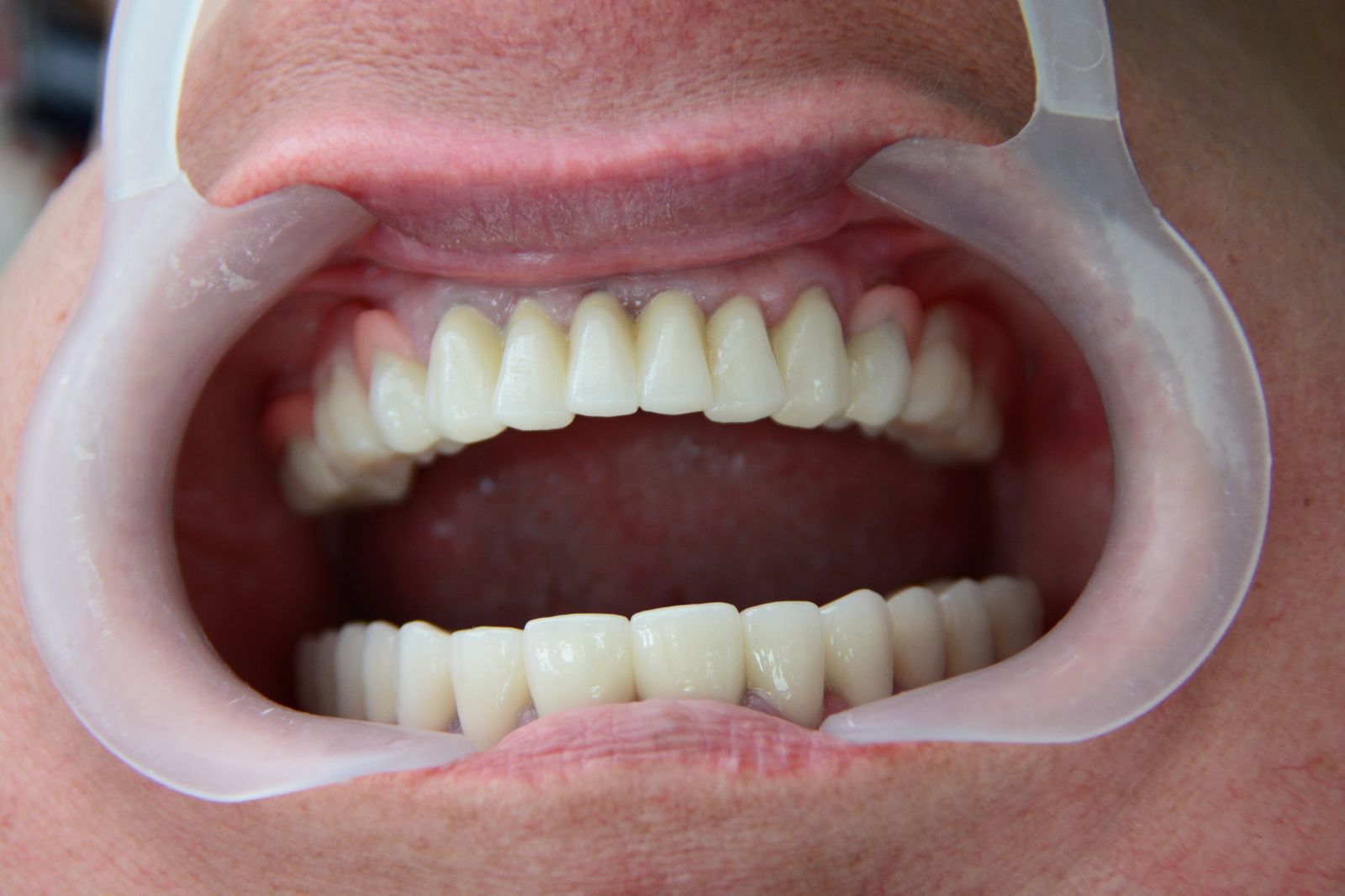 Протезирование фото до и после лечения зубов в стоматологии