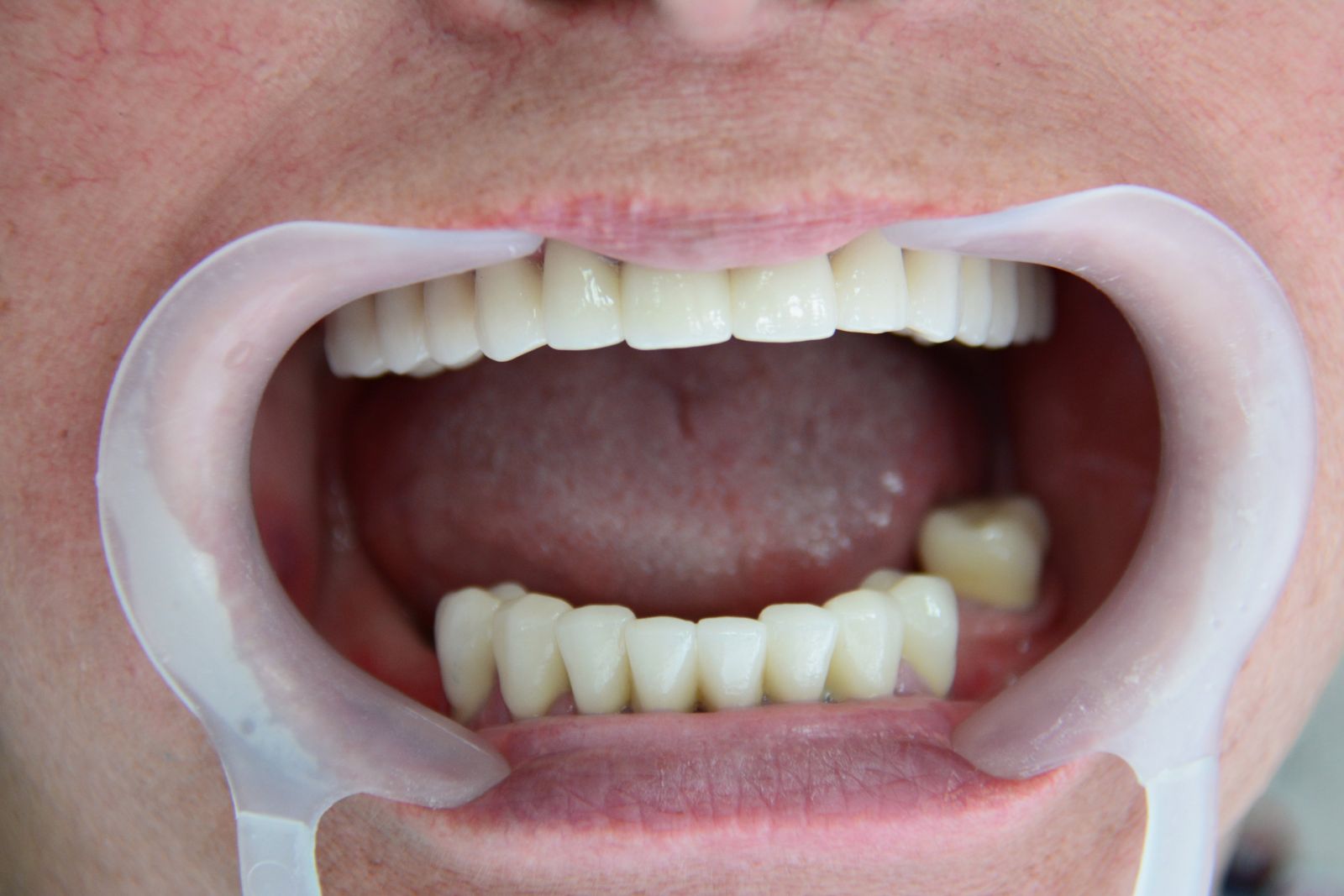 Установка металлокерамической коронки на зуб фото до и после