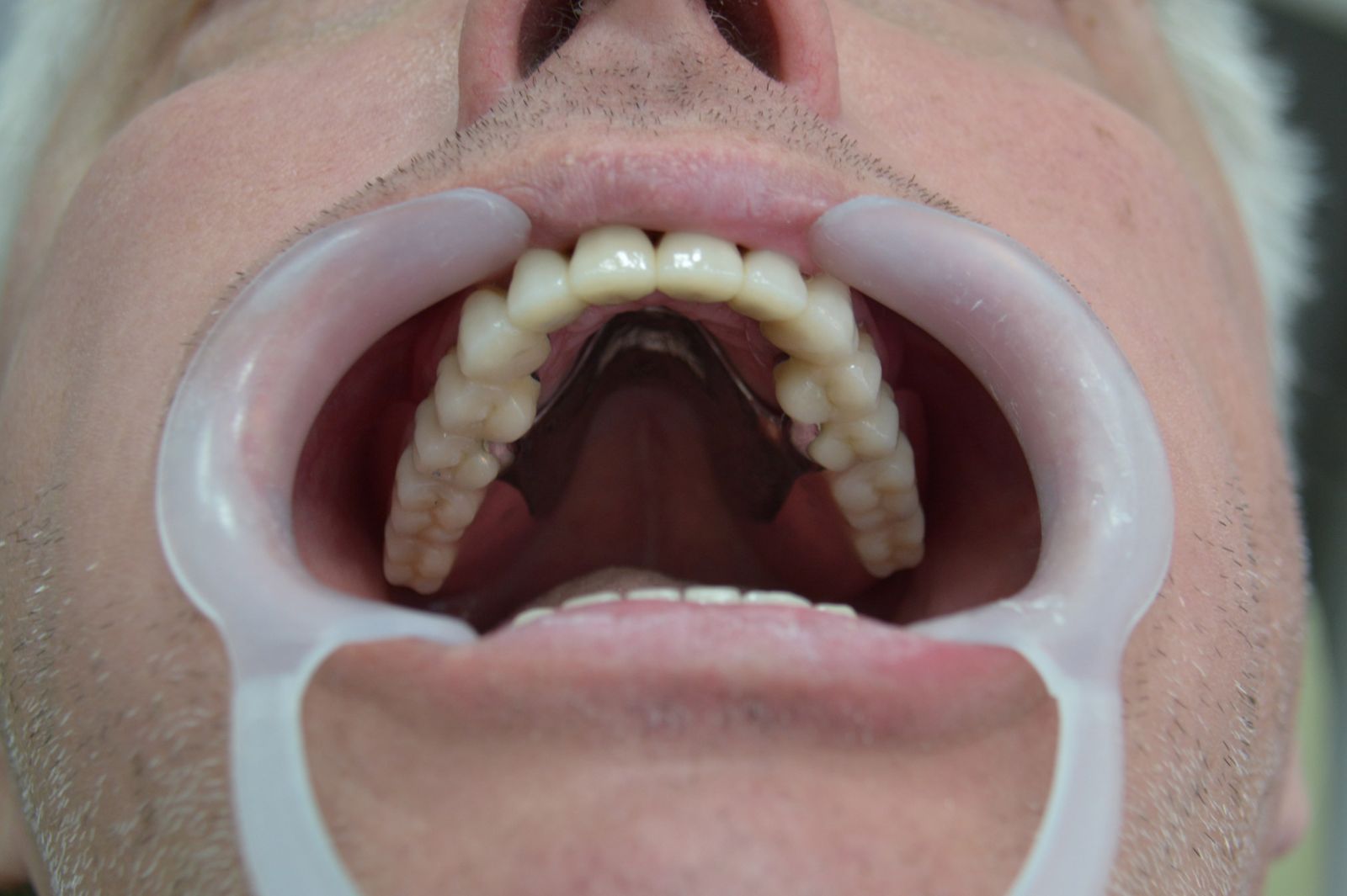 Съемные зубные протезы фото до и после, стоматология Минска