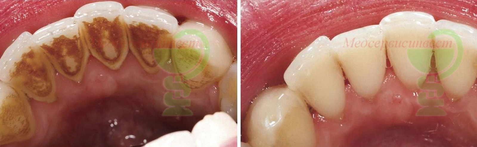 Шинирование зубов цены стекловолоконной лентой лечение десен фото