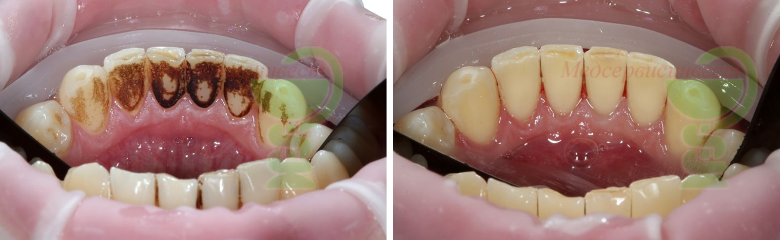 Профгигиена полости рта: десен и зубов - фото до и после