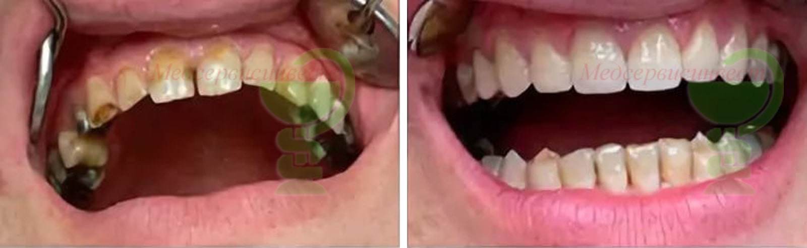 Зубные протезы, металлокерамическая коронка на зуб цена фото