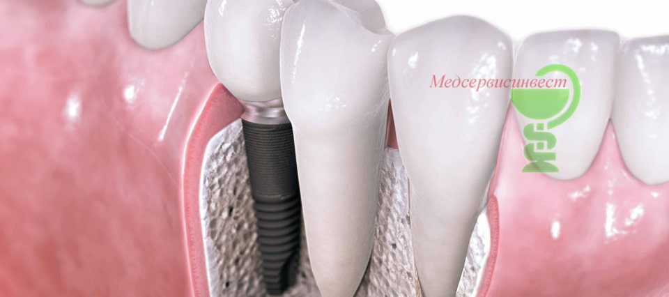 Зубные протезы из металлокерамики фото установки какие лучше выбрать