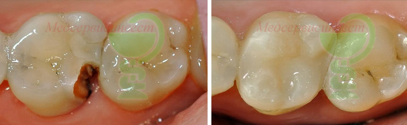 Современное лечение кариеса зубов в стоматологии Минска фото до и после