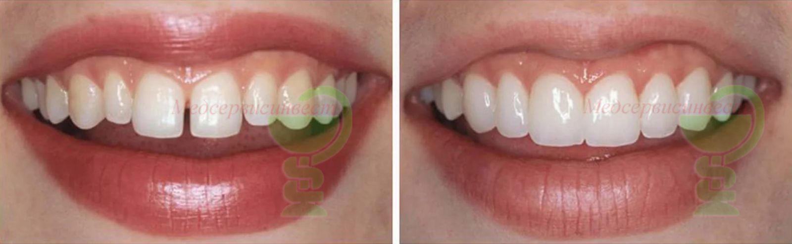 Установка винир на зубы в Минске фото до и после Медсервисинвест