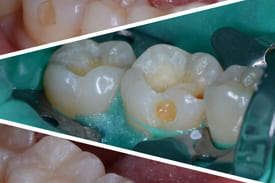 Зубные протезы или восстановление зубного ряда